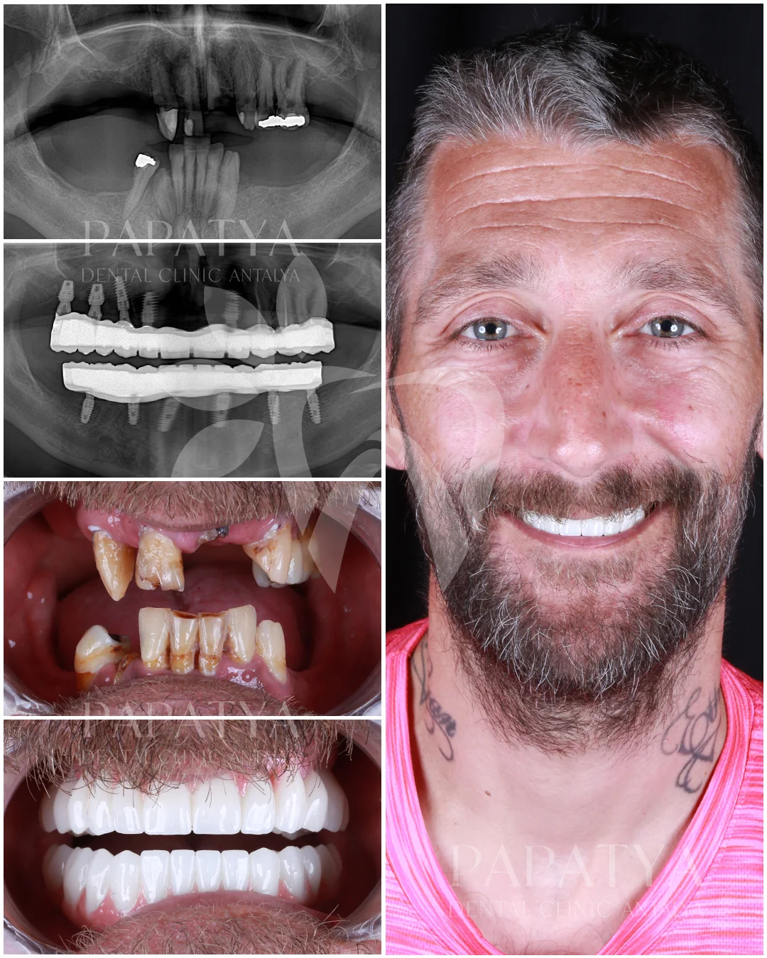 All-on-6 İmplantlar