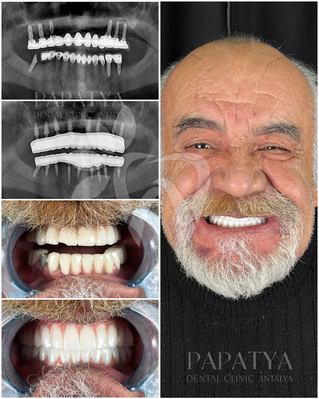 72 Saatte İmplant Üstü Sabit Diş Tedavisi