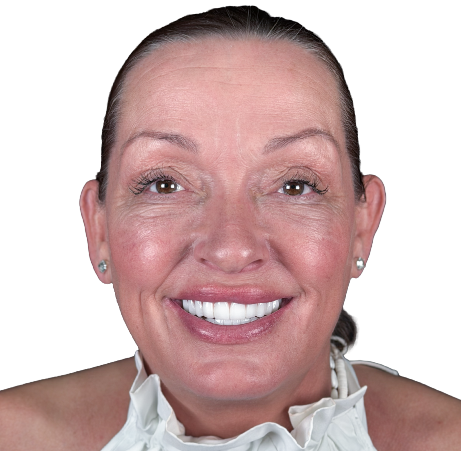 Hollywood Smile: Etter